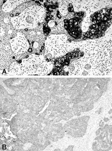 Cytokeratin 7 And Cytokeratin Expression In Epithelial Neoplasms A Survey Of 435 Cases Modern Pathology