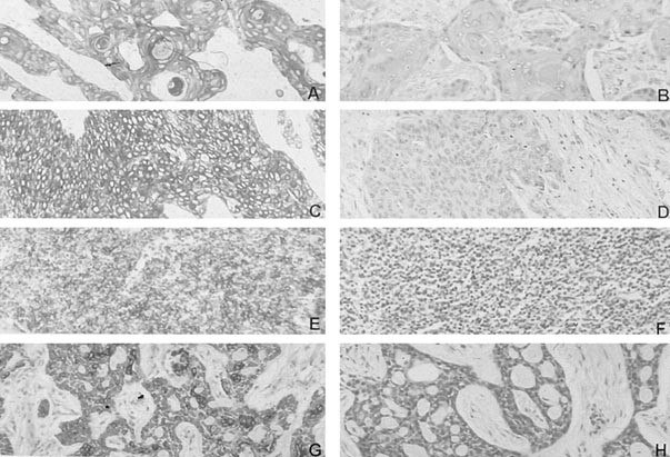 Expression Of Cytokeratin 5 6 In Epithelial Neoplasms An Immunohistochemical Study Of 509 Cases Modern Pathology