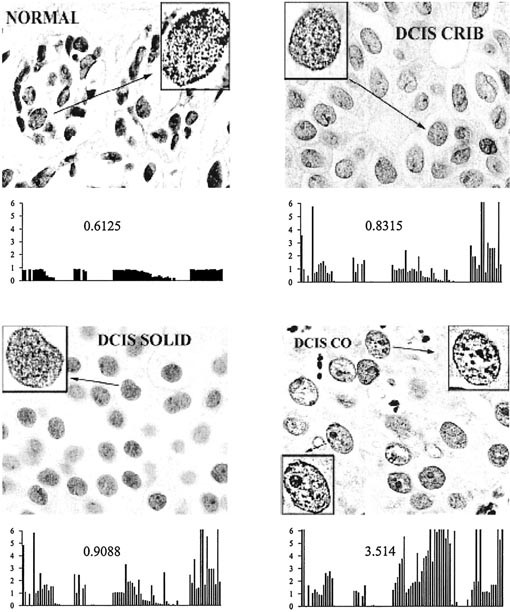 Quantitative Study Of Breast Cancer Progression Different