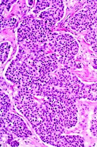 Neuroectodermal Neoplasms of the Head and Neck with Emphasis on  Neuroendocrine Carcinomas | Modern Pathology
