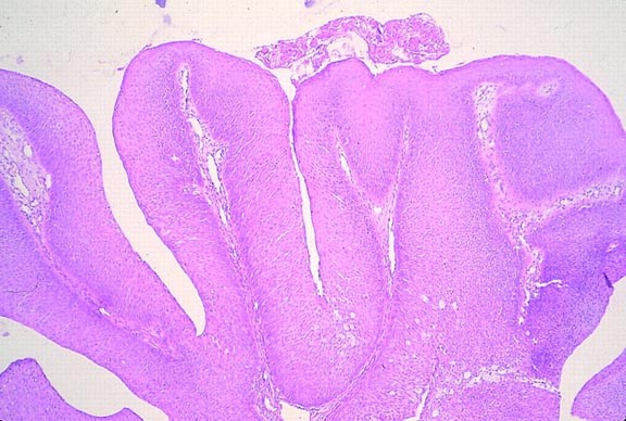 papilloma skin histology