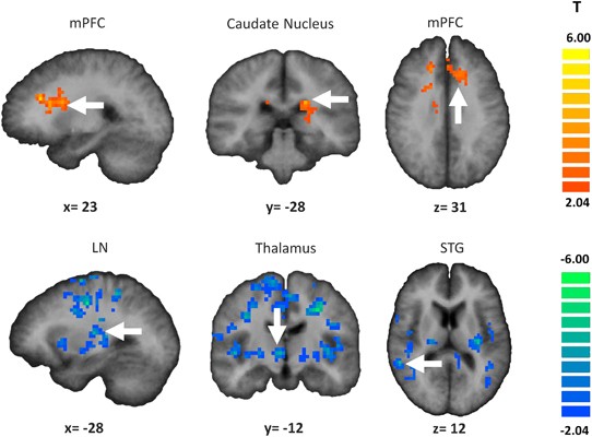 schizophrenia auditory hallucinations