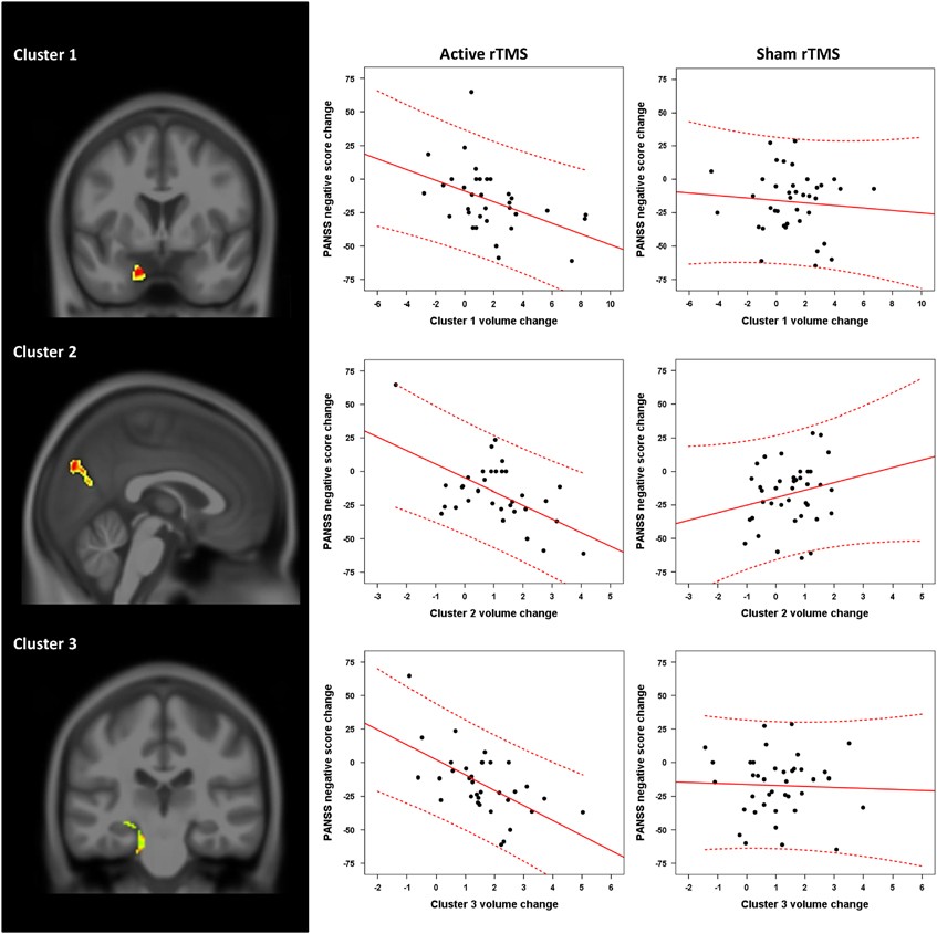 Structural brain changes are associated with response of negative symptoms  to prefrontal repetitive transcranial magnetic stimulation in patients with  schizophrenia | Molecular Psychiatry