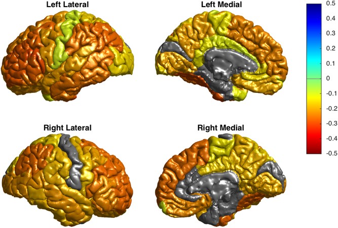 Cortical Abnormalities In Bipolar Disorder An Mri Analysis Of 6503 Individuals From The Enigma Bipolar Disorder Working Group Molecular Psychiatry