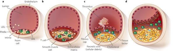 Translating molecular discoveries into new for atherosclerosis