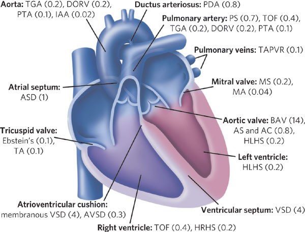 congenital heart disease