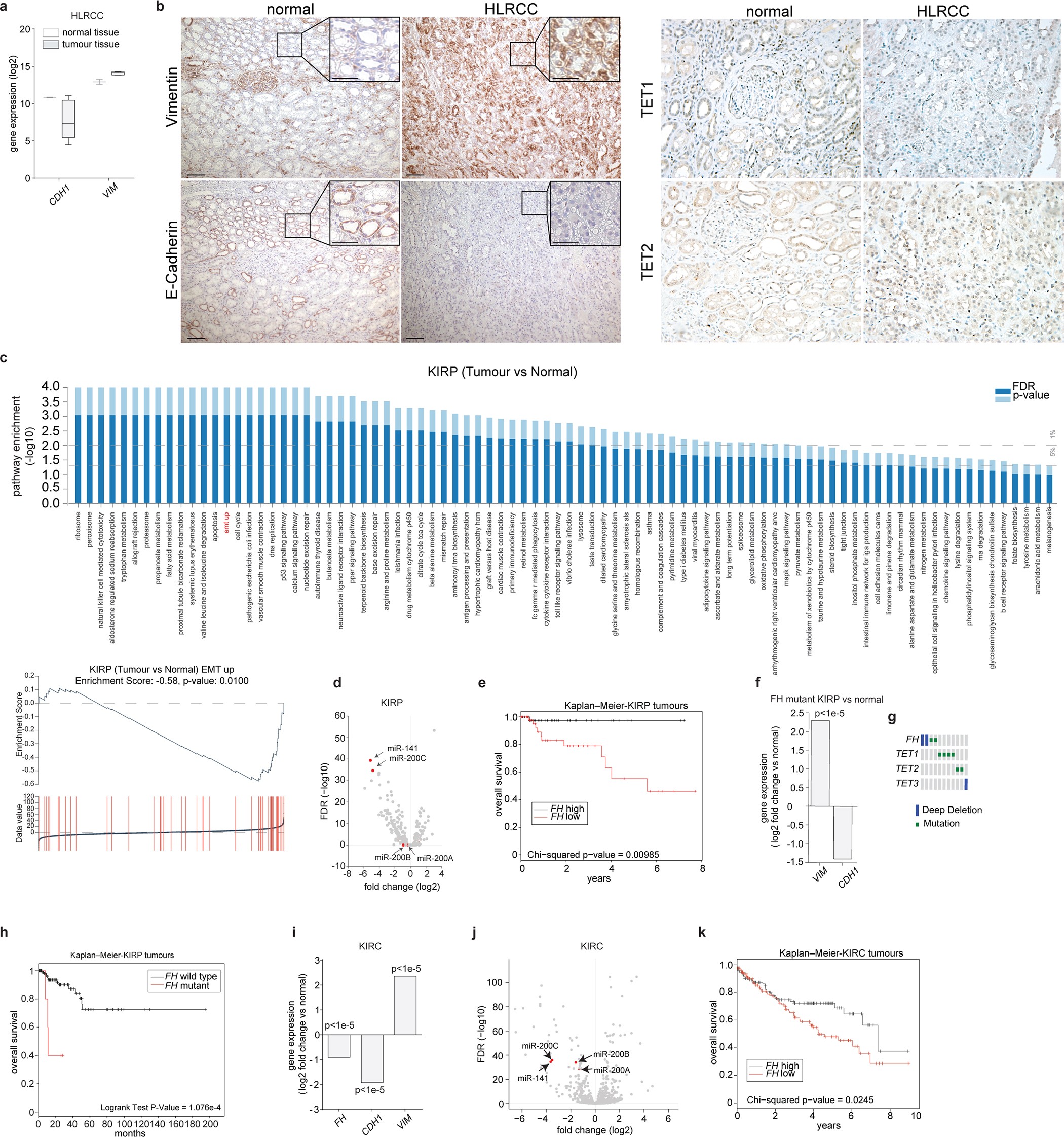 Extended Data Figure 10: Expression of FH and EMT markers in kidney cancer.