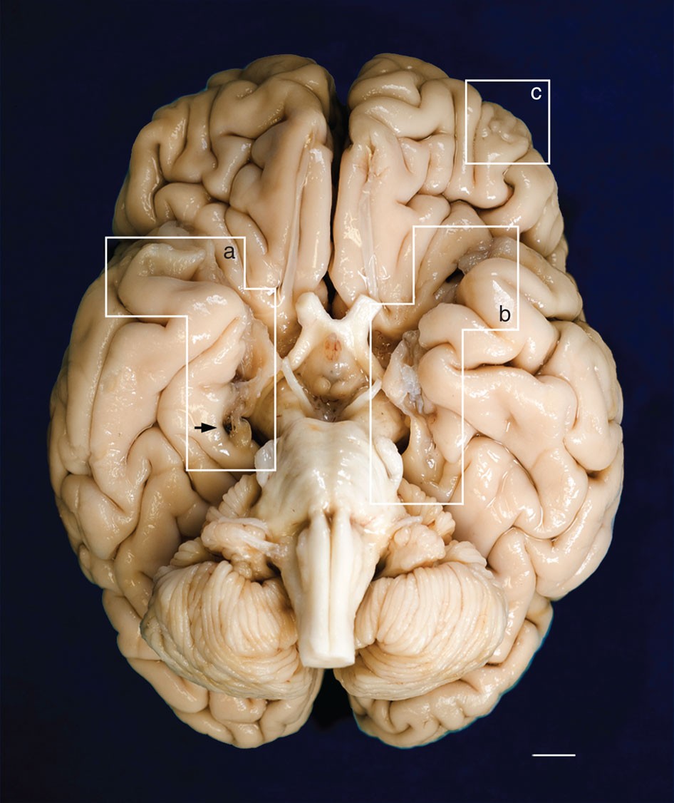 Postmortem Examination Of Patient H M S Brain Based On