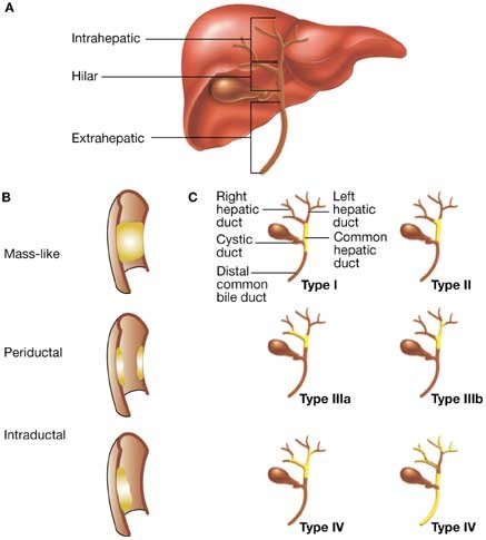Cholangiocarcinoma | Nature Reviews Gastroenterology & Hepatology