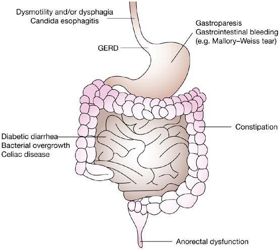 diabetic diarrhea clonidine