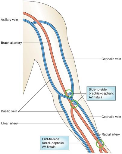 brachial cephalic fistula