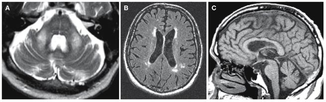Fragile X Associated Tremorataxia Syndromean Older Face Of - 