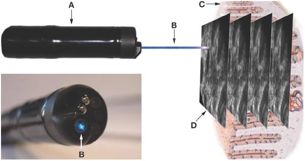 Technology Insight: confocal laser endoscopy for in vivo diagnosis of  colorectal cancer | Nature Reviews Clinical Oncology