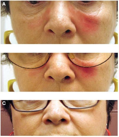 Erratum Malar Rash Caused By Metal Allergy In A Patient With
