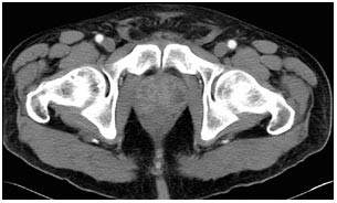 Prostatitis CT vagy MRI. Clinical Research News