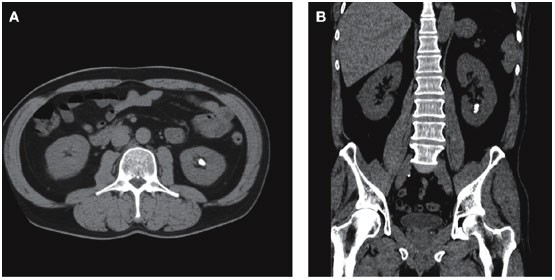 A case of a lower pole renal calculus managed with percutaneous  nephrolithotomy | Nature Reviews Urology