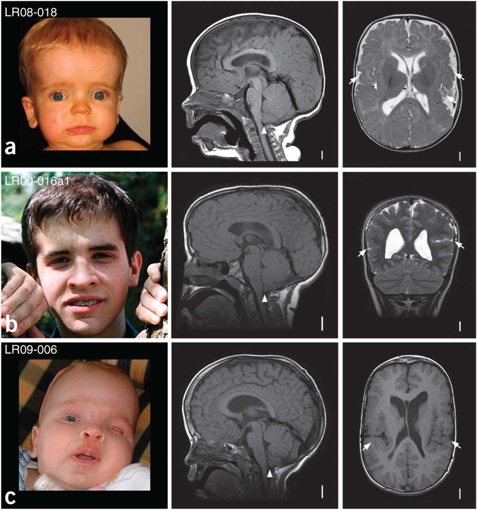 De Novo Germline And Postzygotic Mutations In Akt3 Pik3r2 And Pik3ca Cause A Spectrum Of Related Megalencephaly Syndromes Nature Genetics