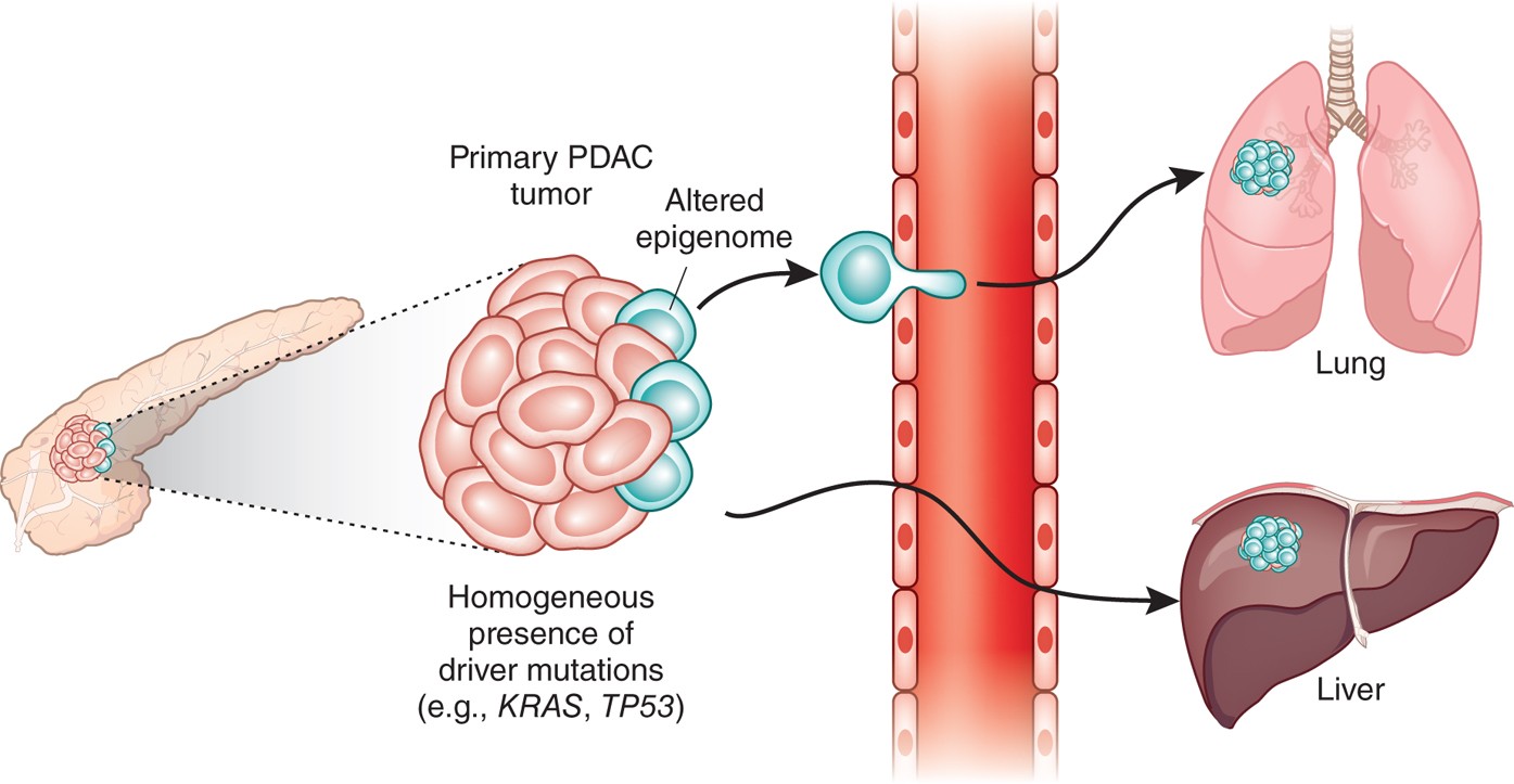 Untangling the genetics from the epigenetics in pancreatic cancer metastasis | Nature Genetics Untangling the genetics from the epigenetics in pancreatic cancer metastasis | Nature Genetics