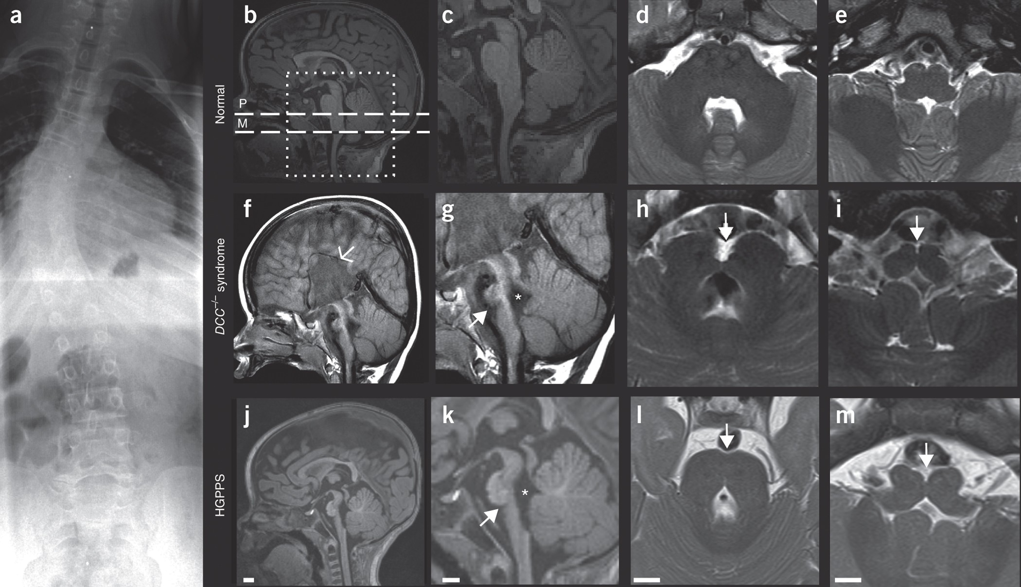 Biallelic Mutations In Human Dcc Cause Developmental Split - 