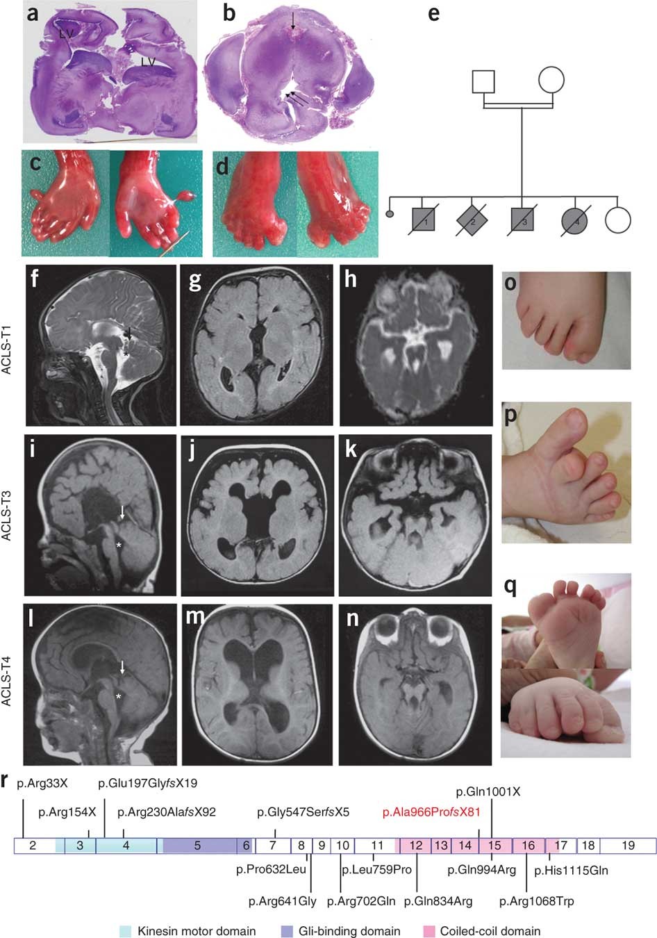 KIF7 mutations cause fetal hydrolethalus and acrocallosal syndromes |  Nature Genetics