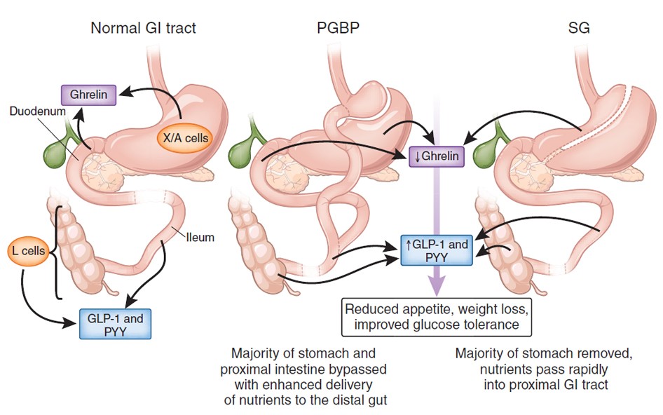 gastric bypass and glp 1 Shedding pounds after going under the knife: Metabolic insights from  cutting the gut