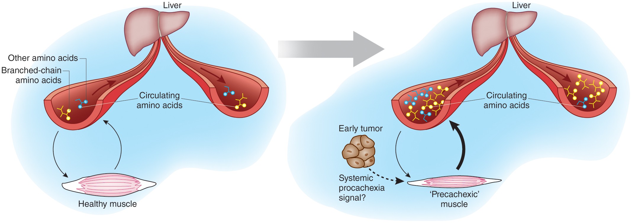 Protein breakdown precedes pancreatic tumor development | Nature Medicine