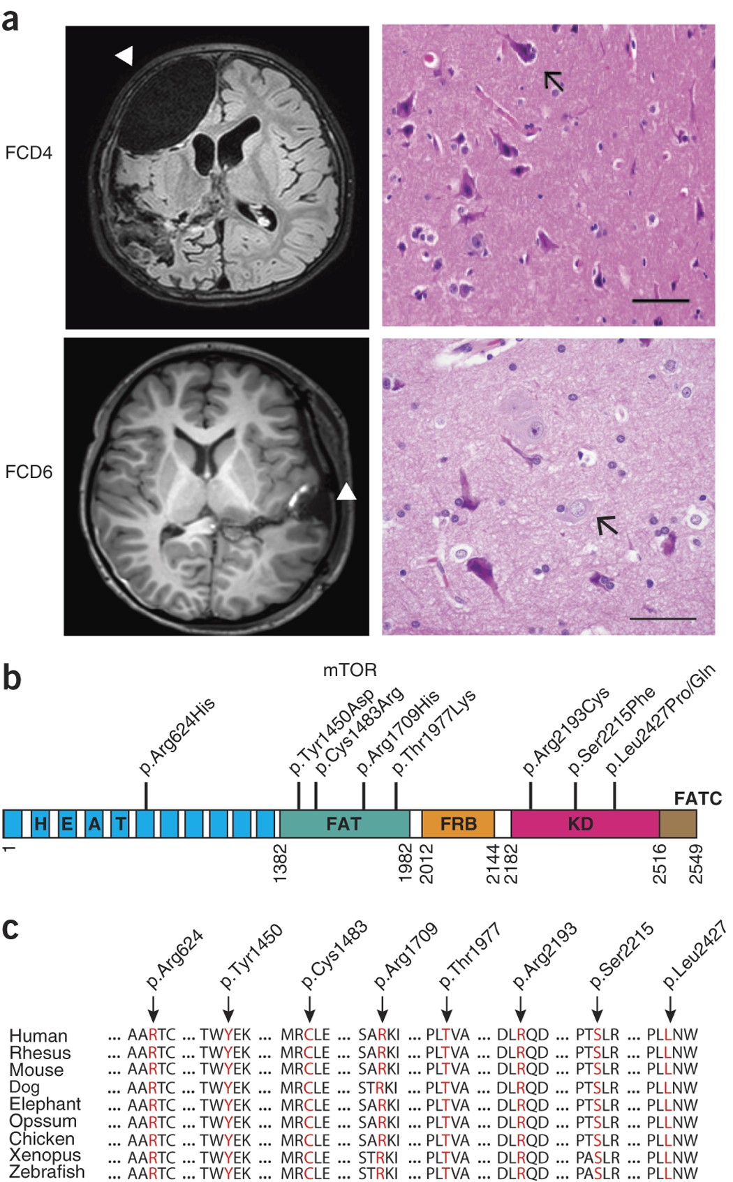 Brain somatic mutations in MTOR cause focal cortical dysplasia type II  leading to intractable epilepsy | Nature Medicine