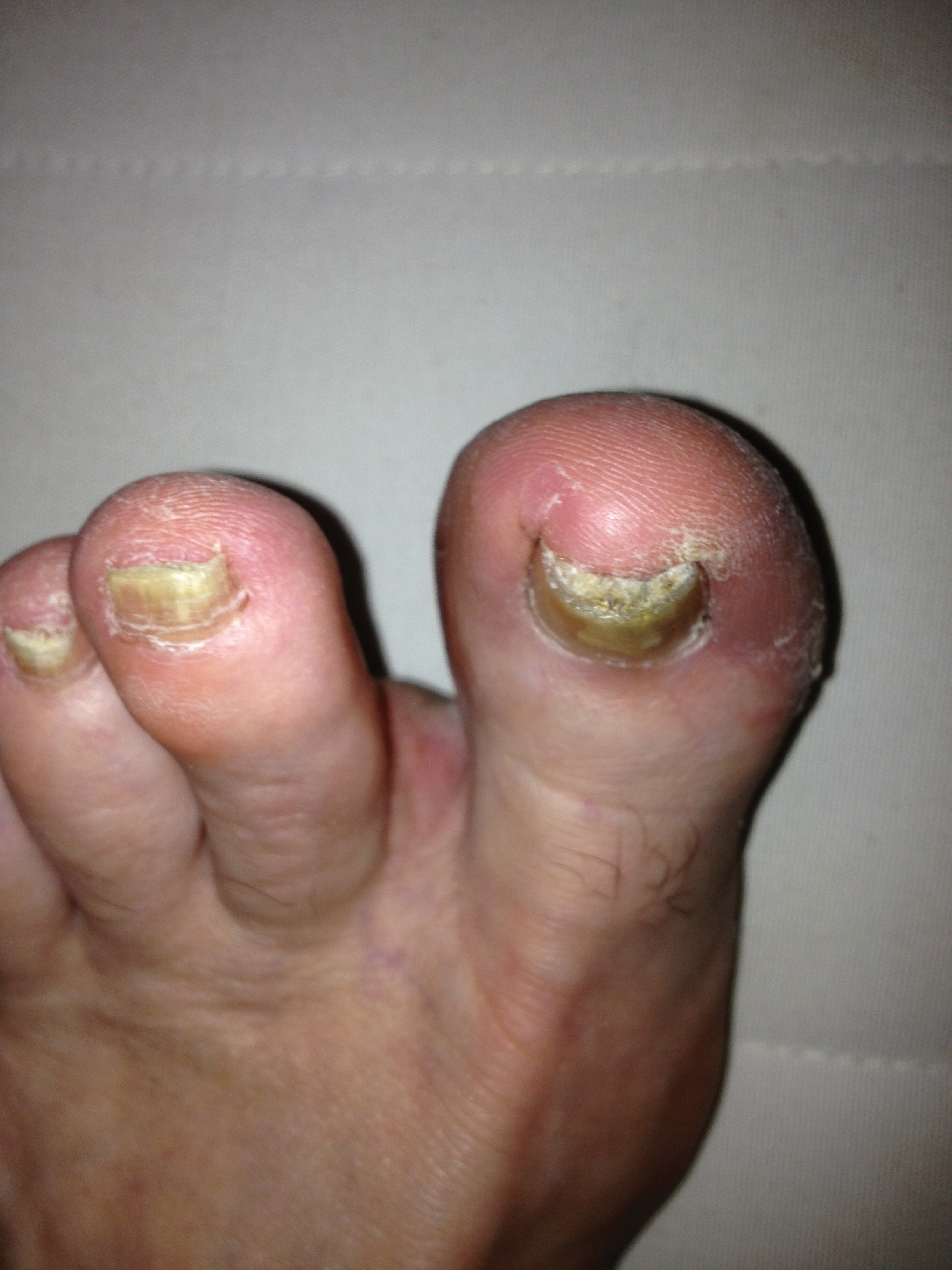 Curled Toe Nails? All About Pincer Nails and Ingrown Toenails