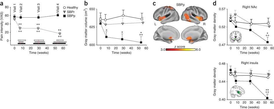 Corticostriatal circuits in the transition to chronic back pain: The  predictive role of reward learning - ScienceDirect