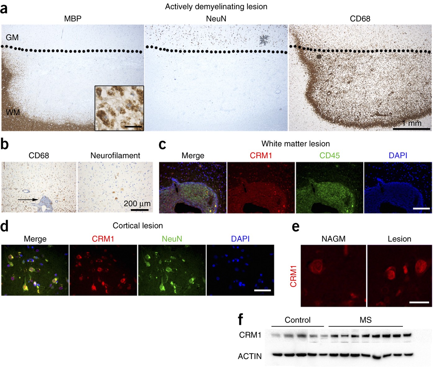 Nuclear export inhibitors avert progression in preclinical ...