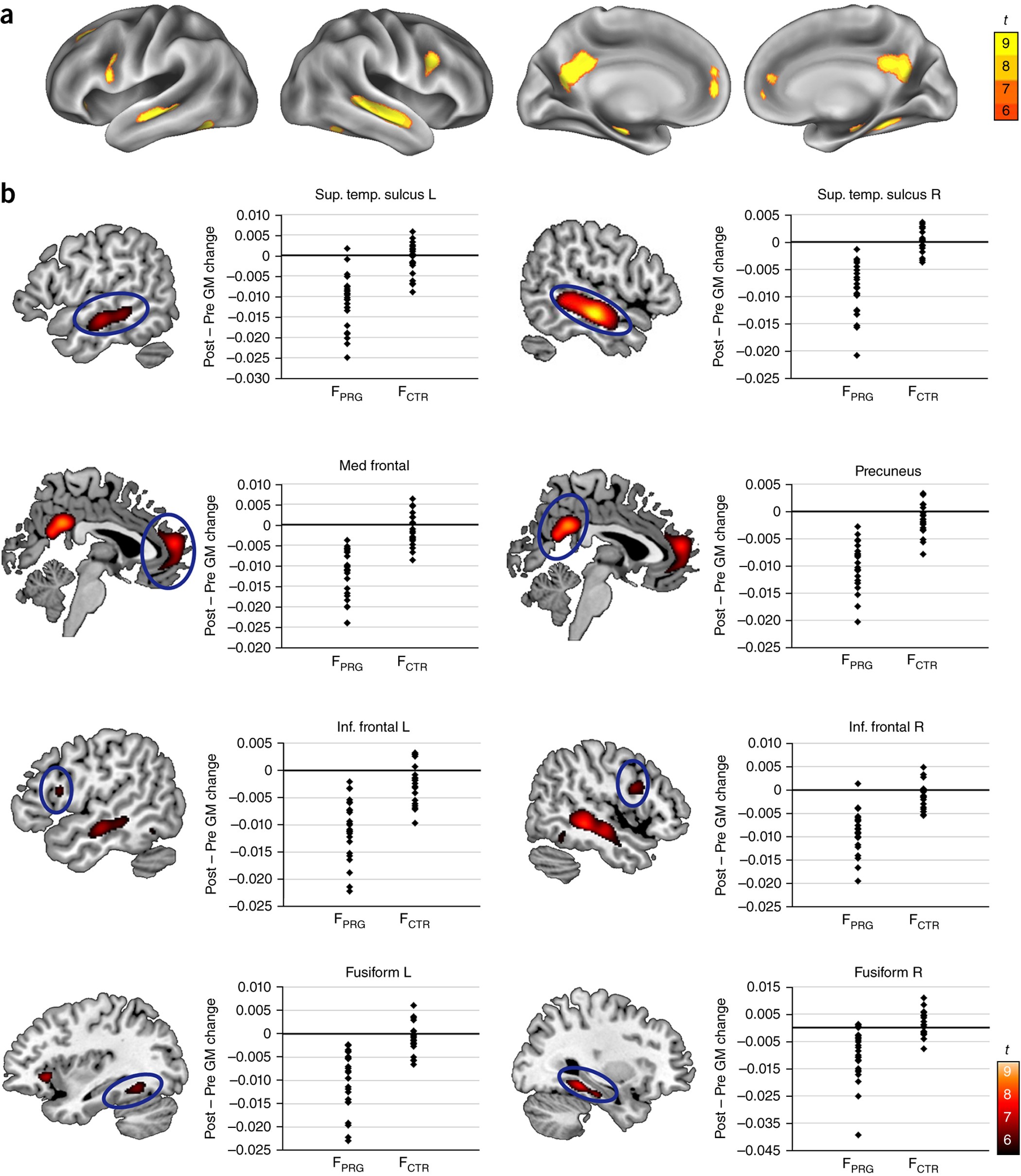 Pregnancy Leads To Long Lasting Changes In Human Brain Structure Nature Neuroscience Pregnancy Leads To Long Lasting Changes In Human Brain Structure Nature Neuroscience
