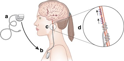 Understanding Vagus Nerve Stimulator (VNS) Placement