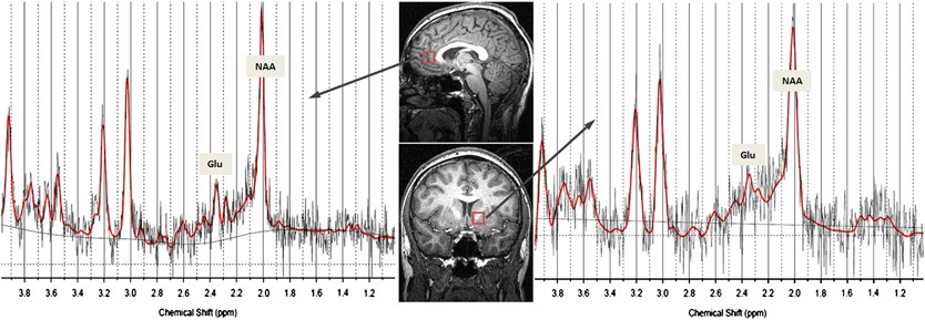 glutathione for alcohol cravings Craving in Alcohol-Dependent Patients After Detoxification Is Related to Glutamatergic Dysfunction in the Nucleus Accumbens and the Anterior Cingulate Cortex Heart & Blood