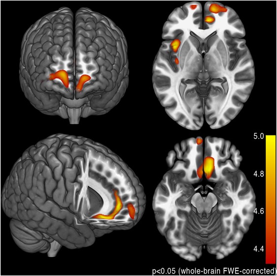 can you smoke cigarettes before mri Current Smoking and Reduced Gray Matter Volume—a Voxel-Based Morphometry  Study
