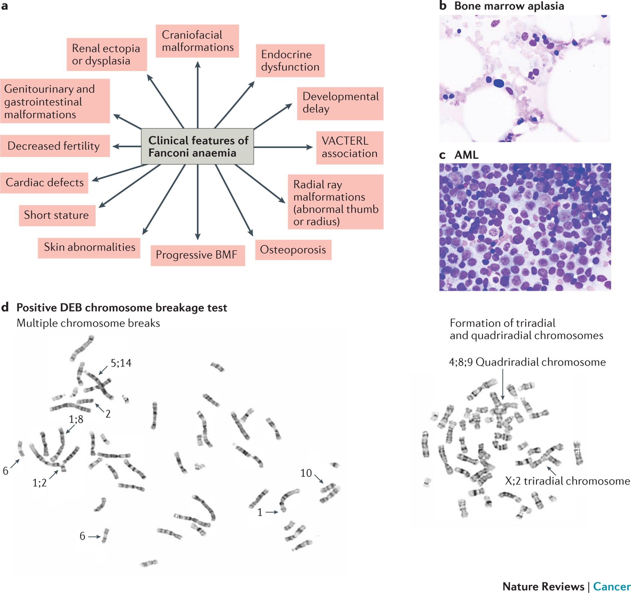 Fanconi anaemia and cancer: an intricate relationship | Nature Reviews  Cancer