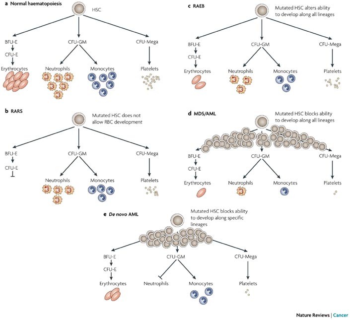 Myelodysplastic Syndromes The Complexity Of Stem Cell Diseases Nature Reviews Cancer Myelodysplastic Syndromes The Complexity Of Stem Cell Diseases Nature Reviews Cancer