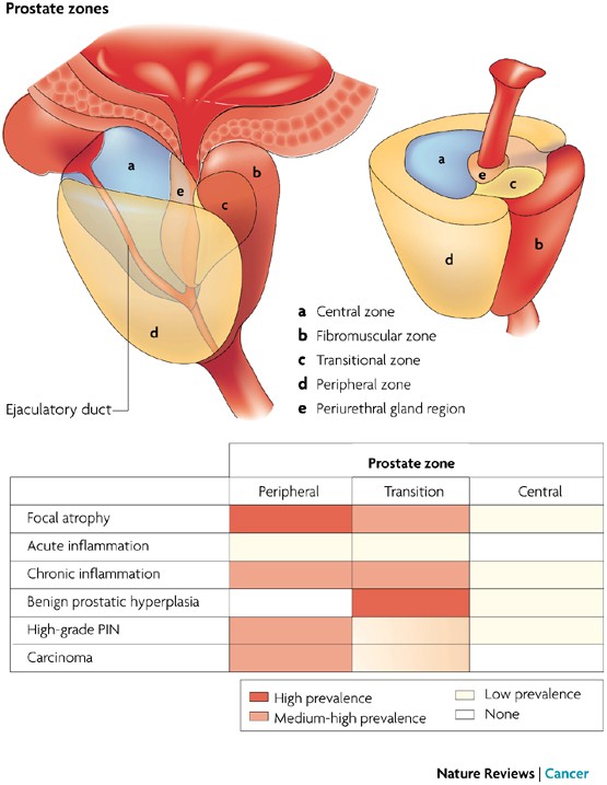 adenocarcinom prostata