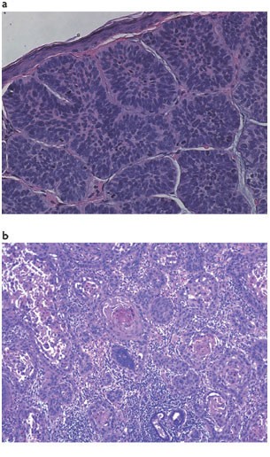 Basal Cell Carcinoma Histology