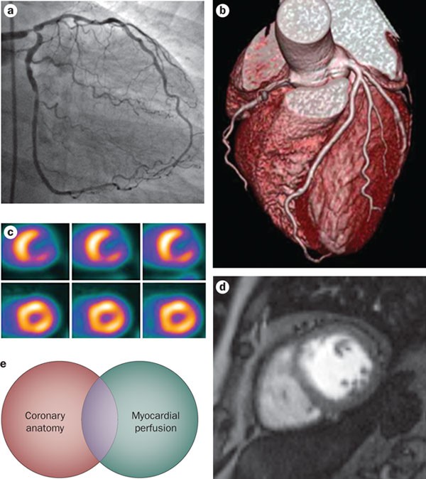 Integration of coronary anatomy and myocardial perfusion imaging | Nature  Reviews Cardiology