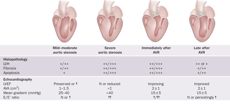 Prognostic Implications of Moderate Aortic Stenosis in Patients With Left  Ventricular Systolic Dysfunction - ScienceDirect