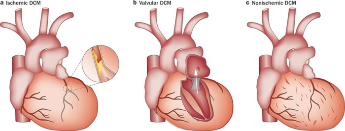 Surgical ventricular restoration for the treatment of heart failure | Nature Reviews Cardiology Surgical ventricular restoration for the treatment of heart failure | Nature Reviews Cardiology