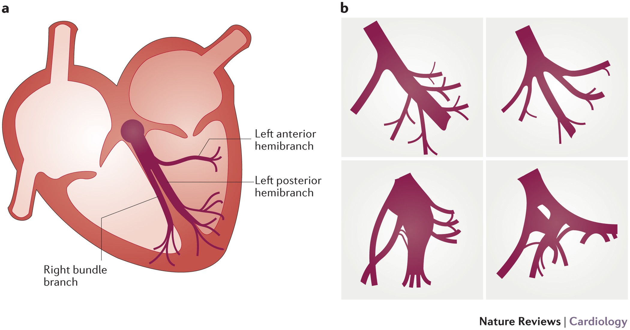 Ventricular arrhythmias and the His–Purkinje system | Nature Reviews  Cardiology
