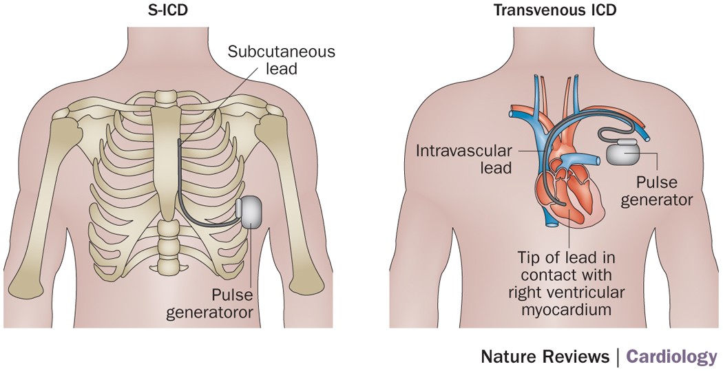 Clinical experience with subcutaneous implantable cardioverter- defibrillators | Nature Reviews Cardiology