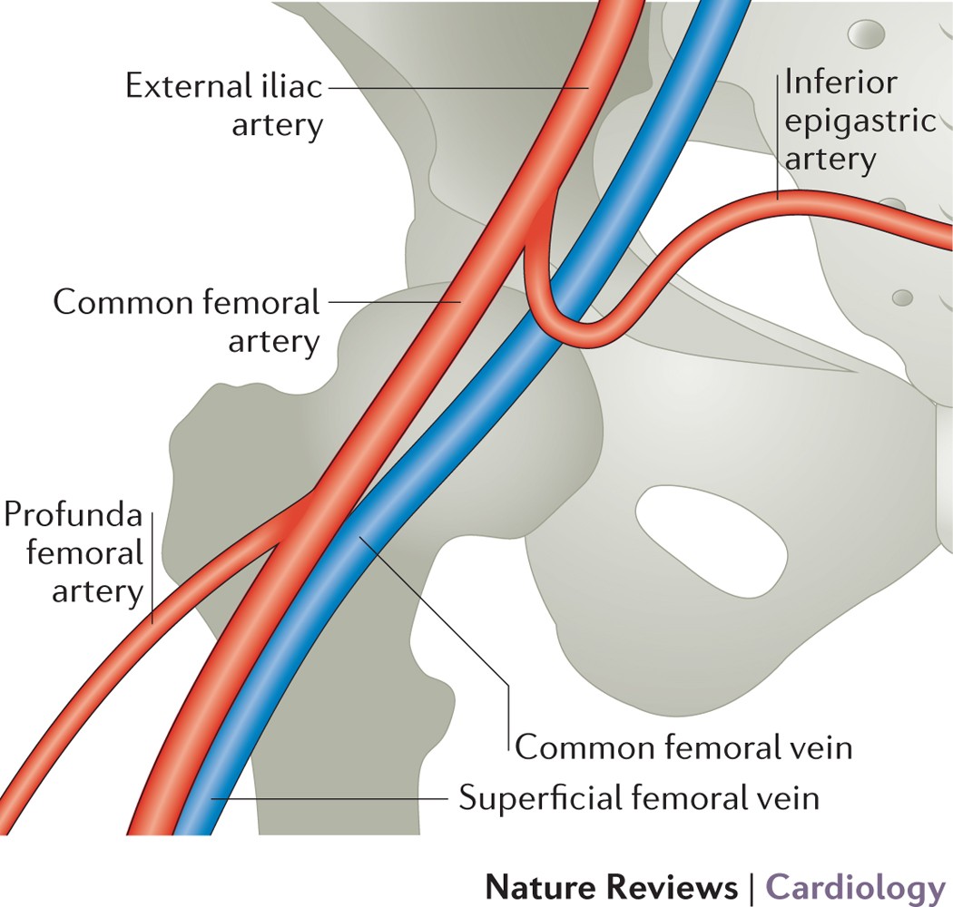 Arterial Access And Arteriotomy Site Closure Devices Nature Reviews Cardiology