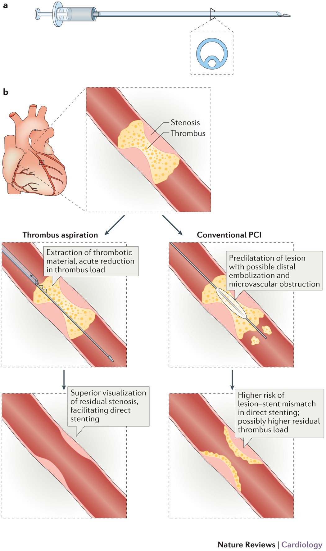 Thrombus aspiration in acute myocardial infarction | Nature Reviews  Cardiology