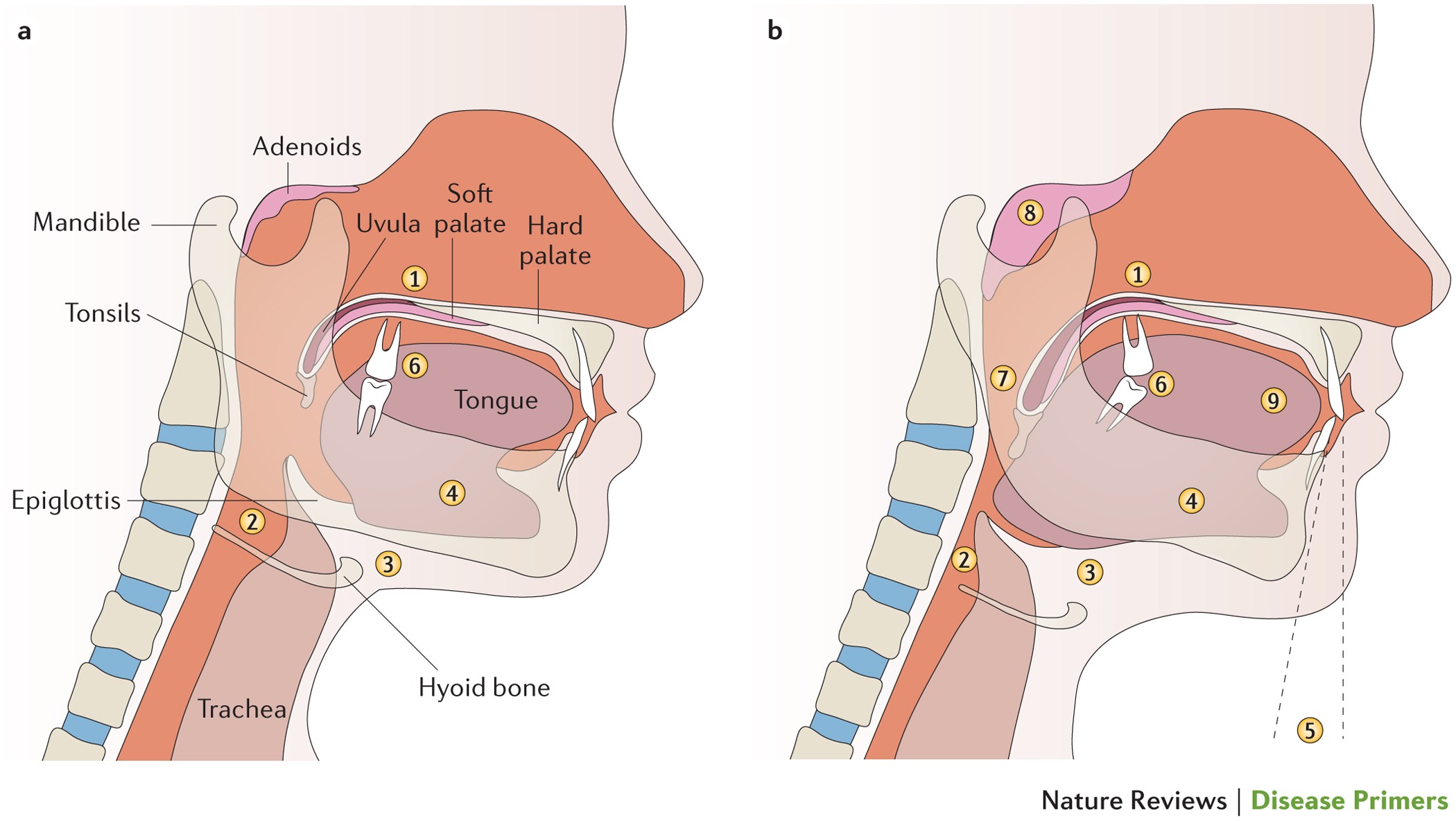 Obstructive sleep apnoea syndrome | Nature Reviews Disease Primers