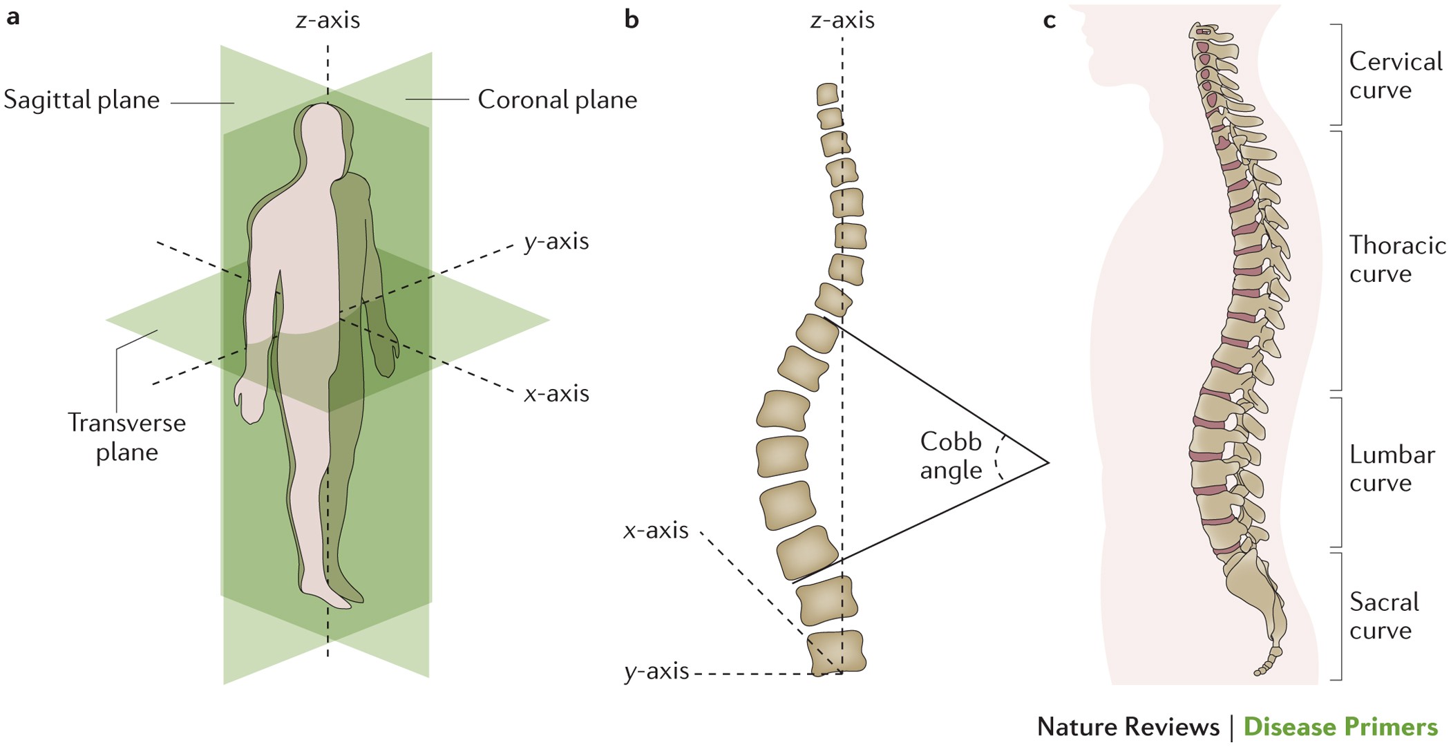 Adolescent idiopathic scoliosis