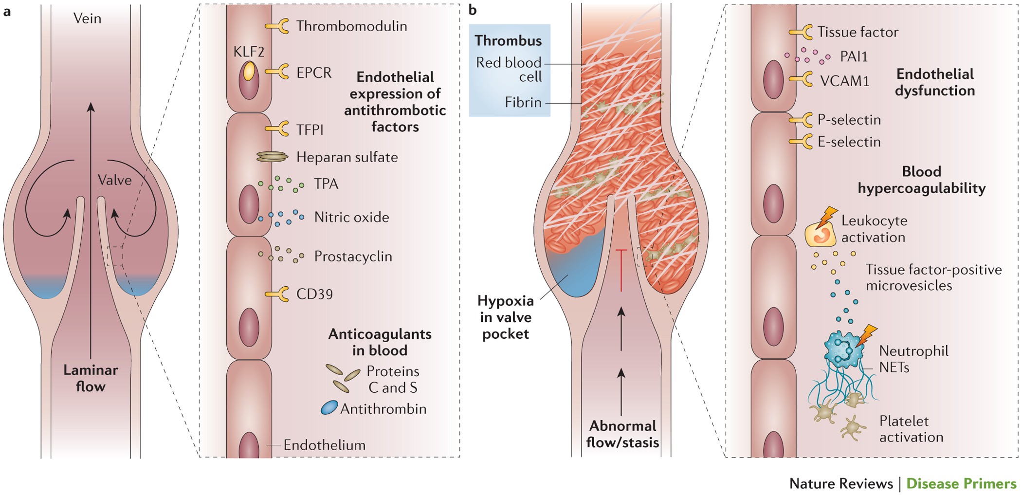 Venous thrombosis | Nature Reviews Disease Primers