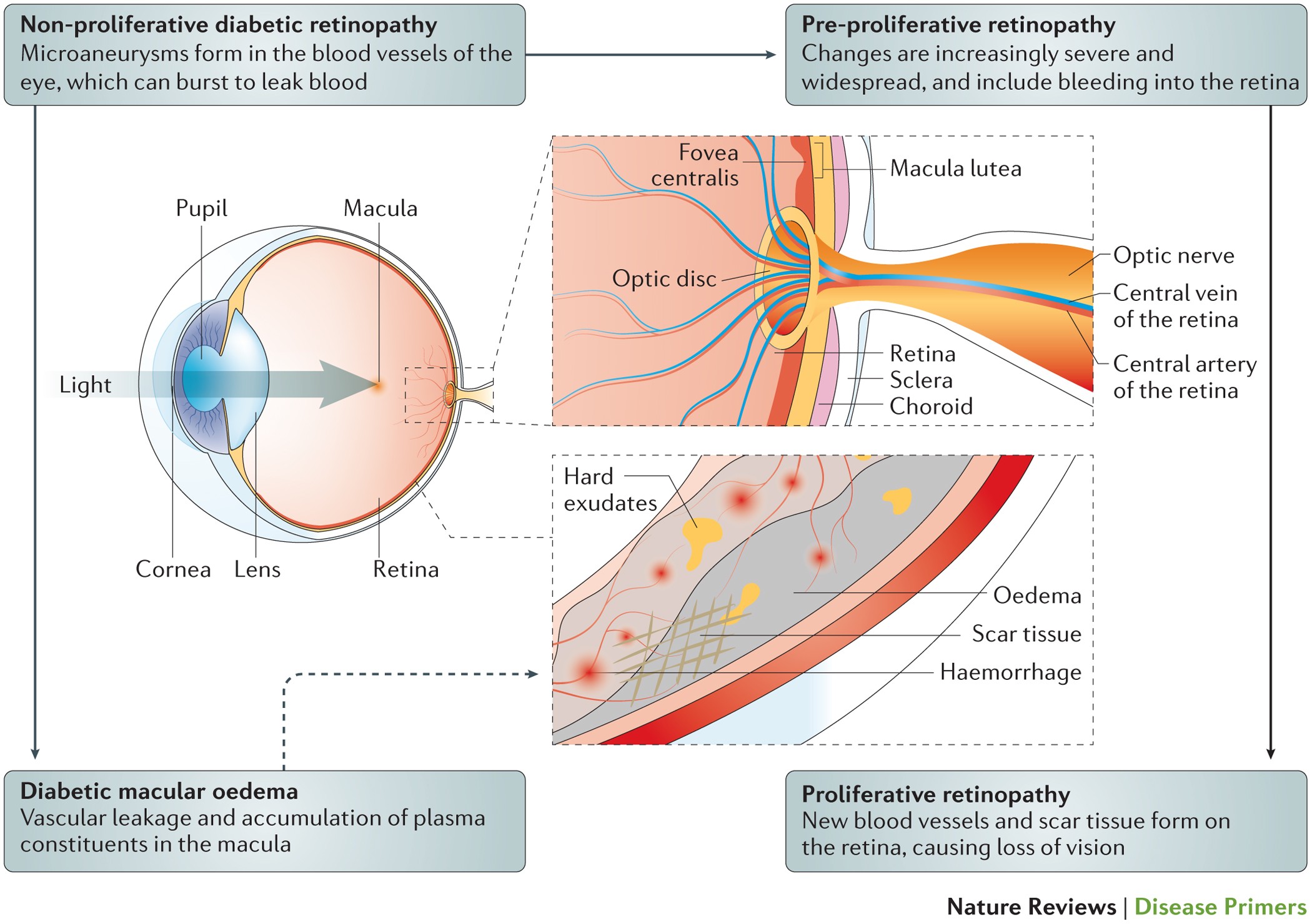 diabetes retina single diabetes)
