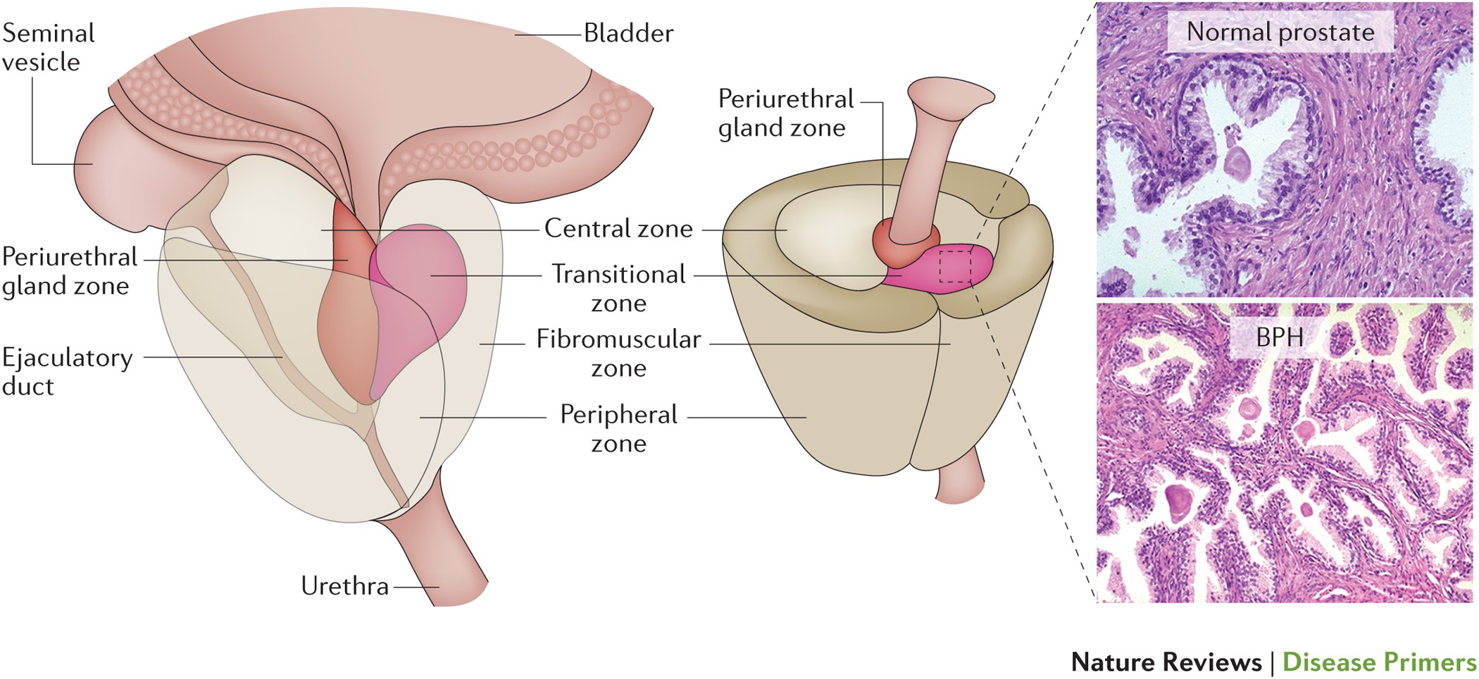 Prostate cancer benign prostatic hyperplasia